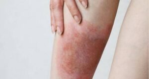 Tot mai mulți români ajung la spital mușcați de căpușe: Medicii trag un semnal de alarmă