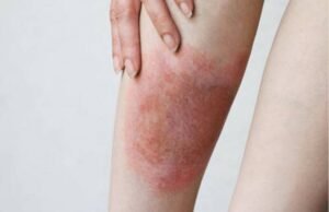 Tot mai mulți români ajung la spital mușcați de căpușe: Medicii trag un semnal de alarmă