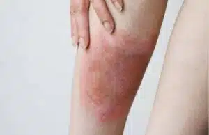 Tot mai mulți români ajung la spital mușcați de căpușe: Medicii trag un semnal de alarmă